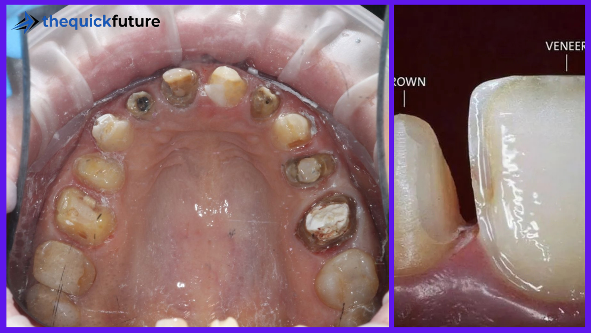 Turkey Teeth Gone Wrong: The Risks, Warning Signs and What to Do Next